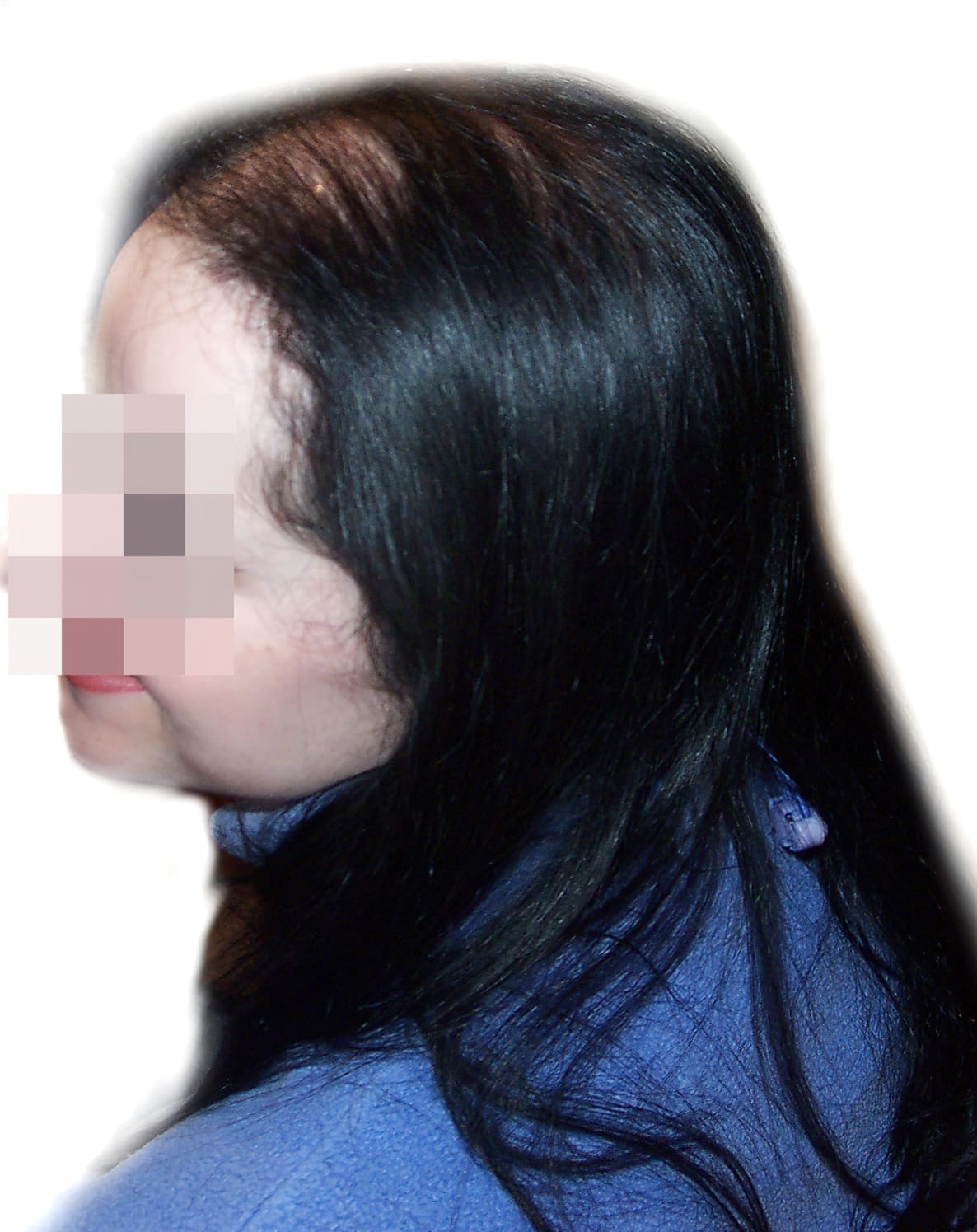 Before Picture - Androgenetic Alopecia